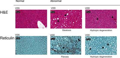 Vitamin D Deficiency During Development Permanently Alters Liver Cell Composition and Function